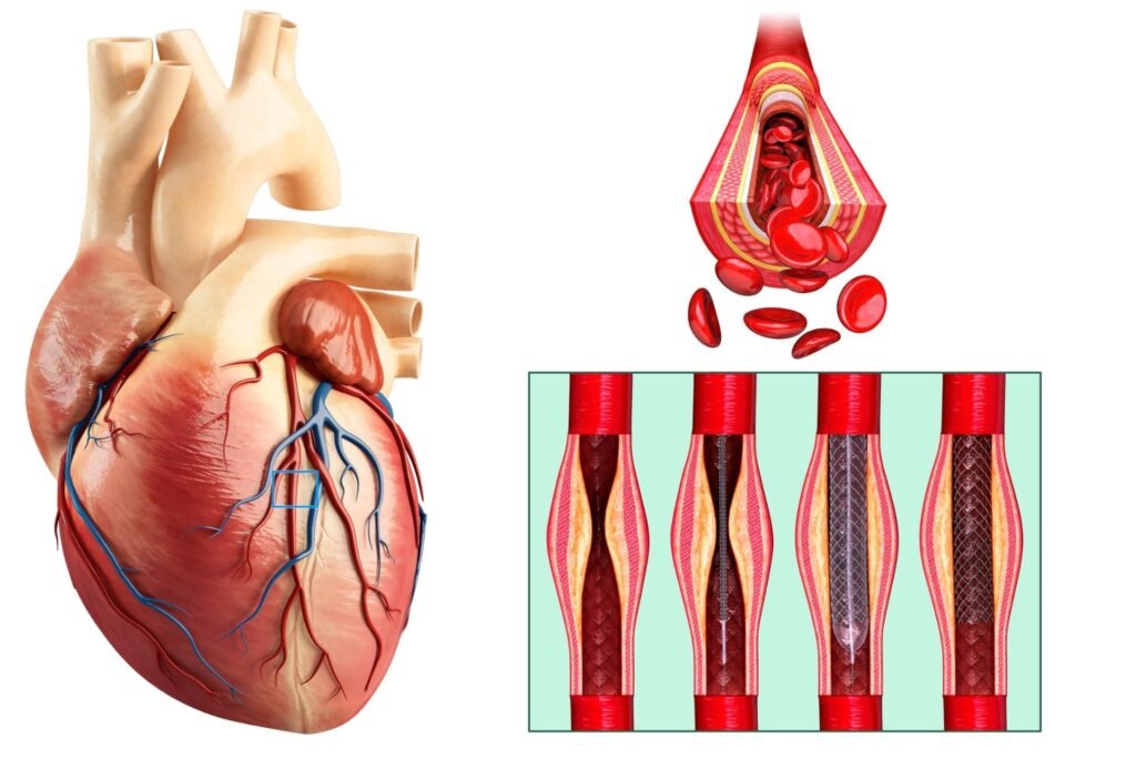 Coronary Angioplasty